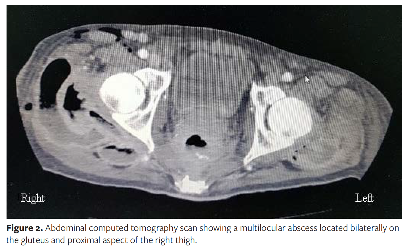 Thigh Abscess Secondary to Intraabdominal Pathologic Conditions